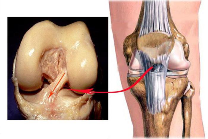 възпаление на сухожилията на колянната става